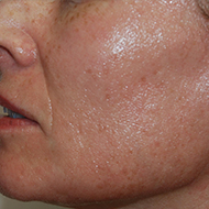 光性老化皮肤